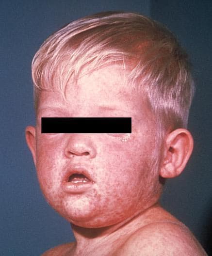 U.S. Measles Cases Hit 35-Year High With Five Months Remaining